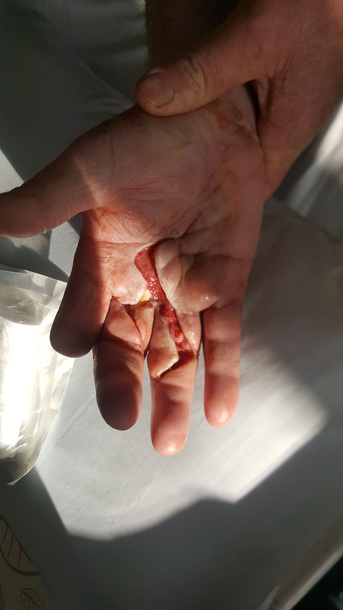 Infection in Hand