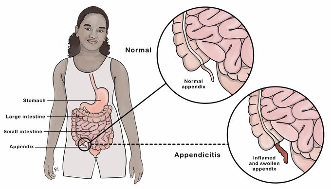 Cause of Appendicitis