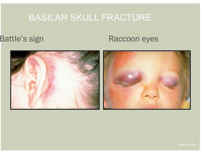 Signs of basilar skull fracture