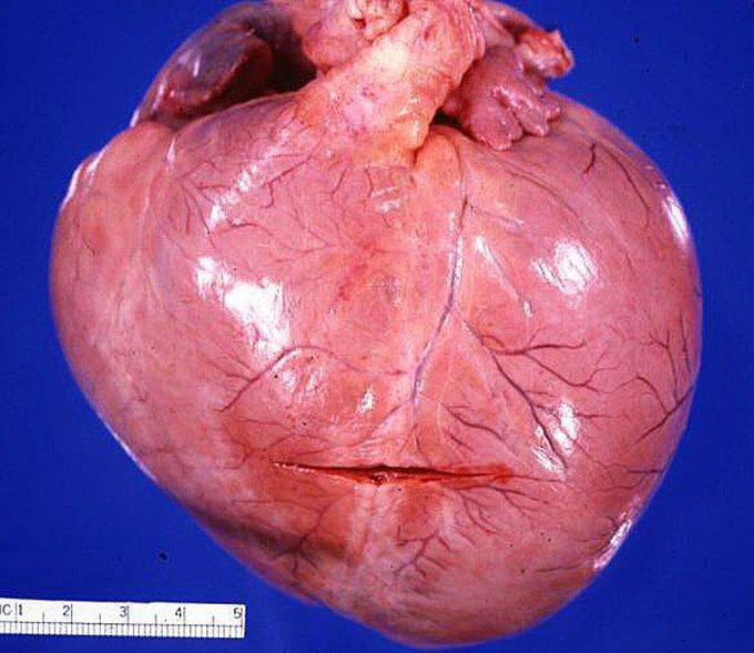 Globular heart