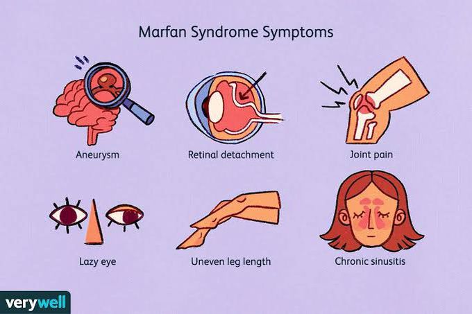 Marfan syndrome symptoms