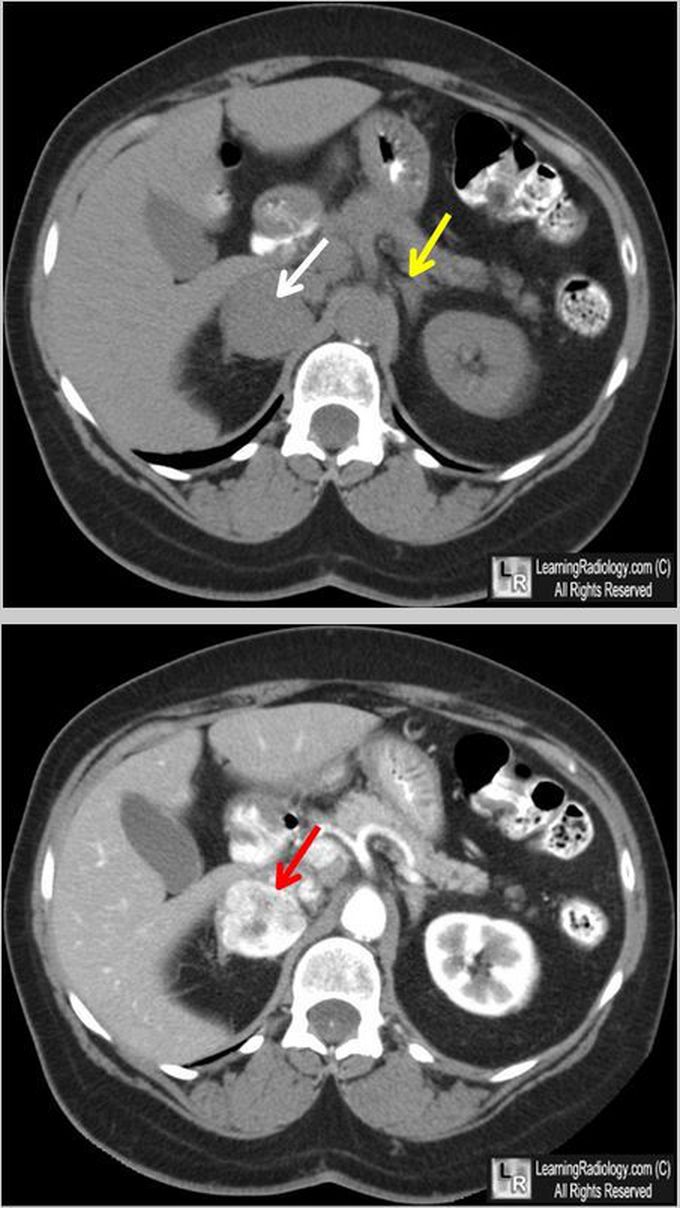 Pheochromocytoma