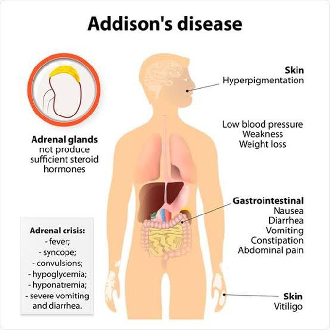 Addison's Disease