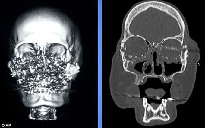 CT scans of the face of Connie Culp
