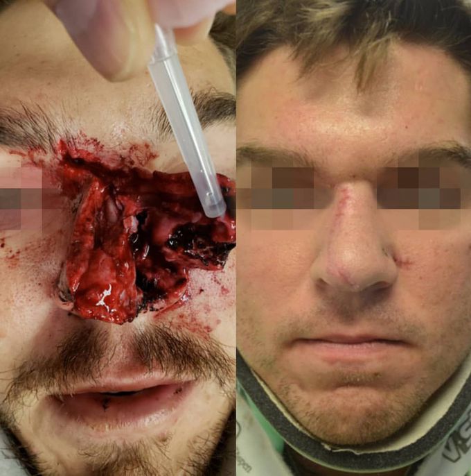 Nasal reconstruction after a car crash! 