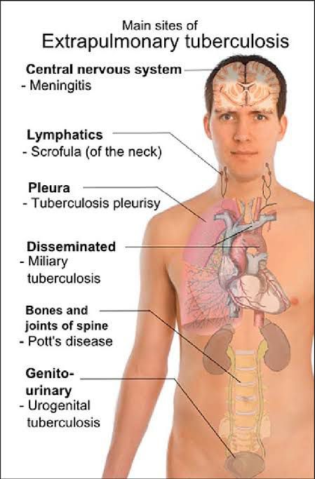 Extrapulmonary Tuberculosis Medizzy 