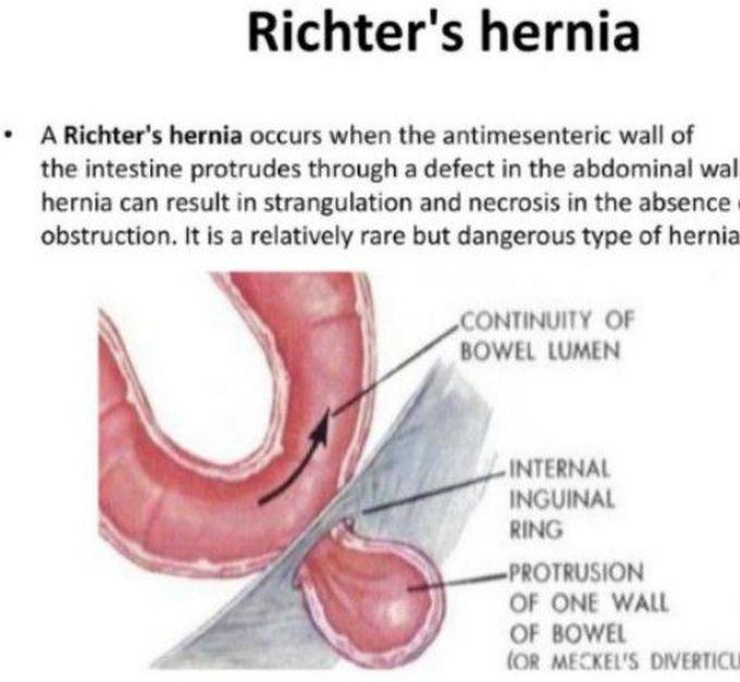 Richter Hernia