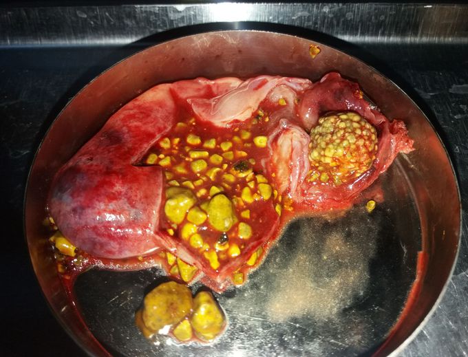 Gall stones