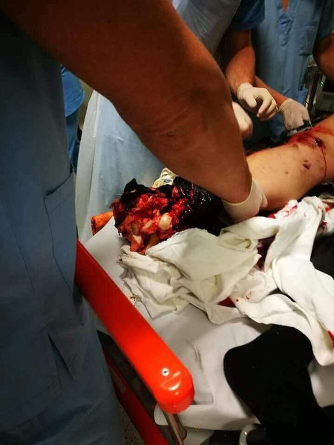 Rider’s foot after an accident