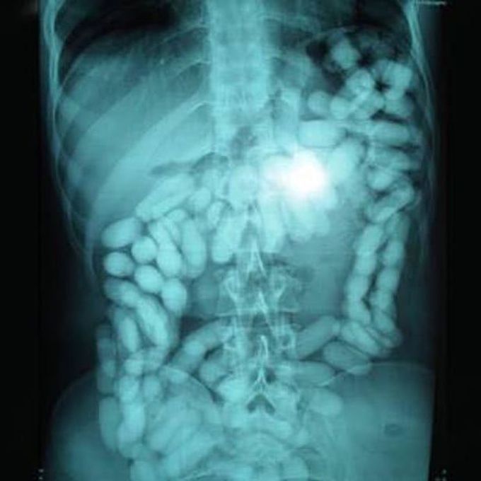 An X-ray showing a man's intentestines and stomach carrying a kilo of cocaine