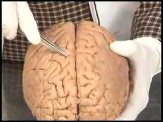 Anatomy of brain- sulcus and gyri