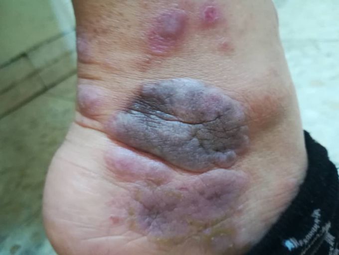 Lichen planus