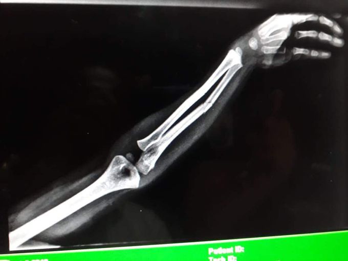 Ulnar fracture