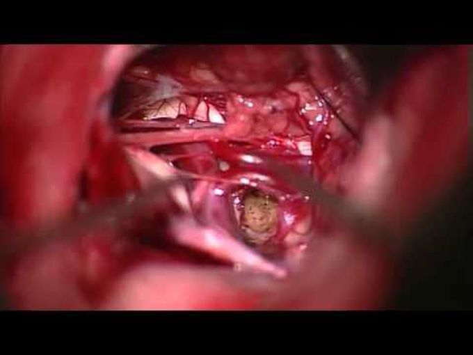 Microsurg resection of medullary cavernoma via olivary zone by retrosigmoid supracondylar approach