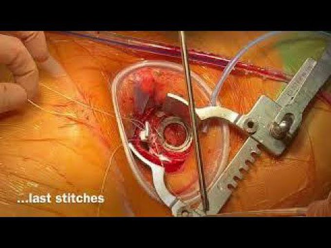 No Visible Scars Implantation of a Continuous Flow Ventricular Assist Device