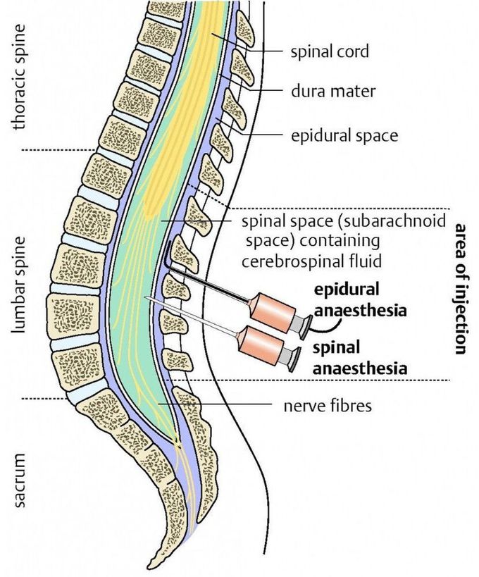 SPINAL VS EPIDURAL ANAESTHESIA