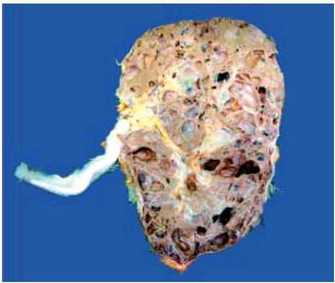 Adult (autosomal dominant) polycystic kidney disease (ADPKD).