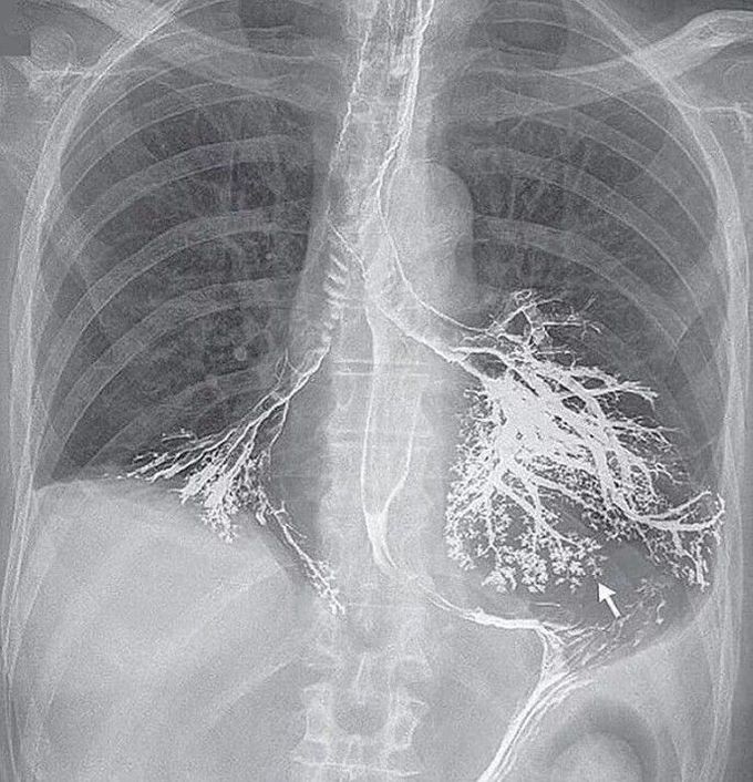 Interprete the chest X-ray