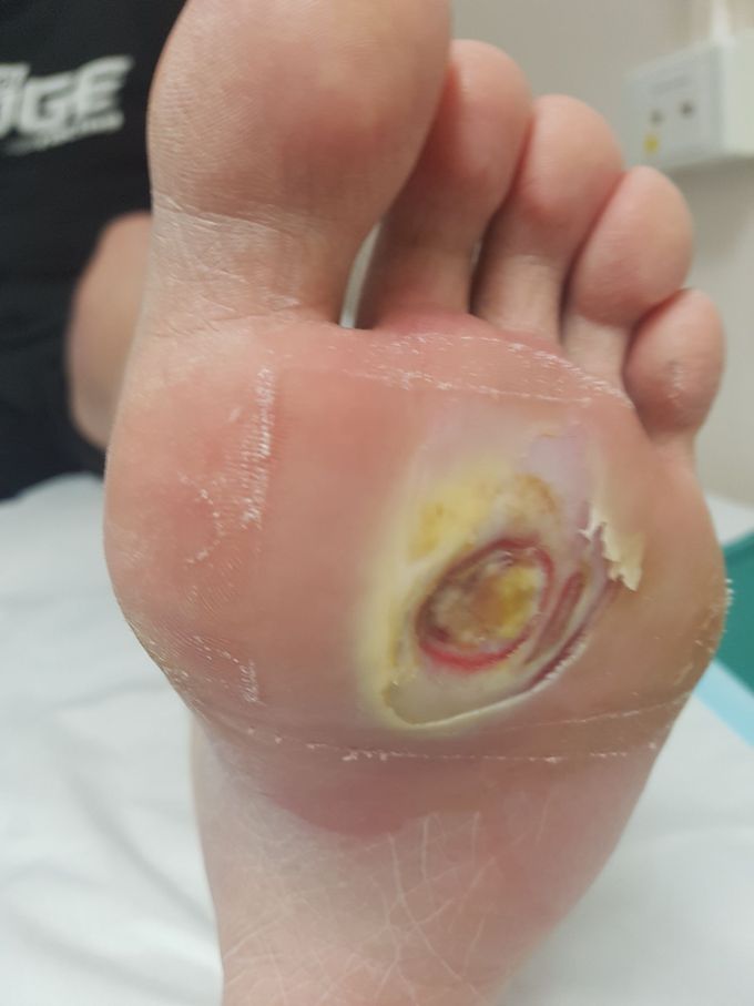 Type 1 diabetic foot ulcer