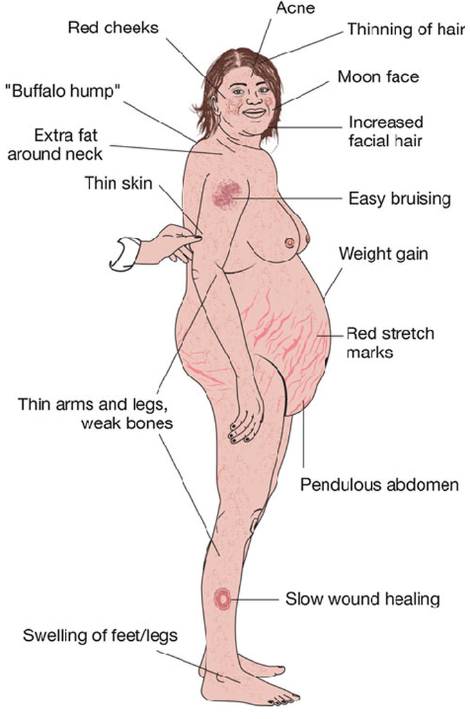 These signs are for what disease?