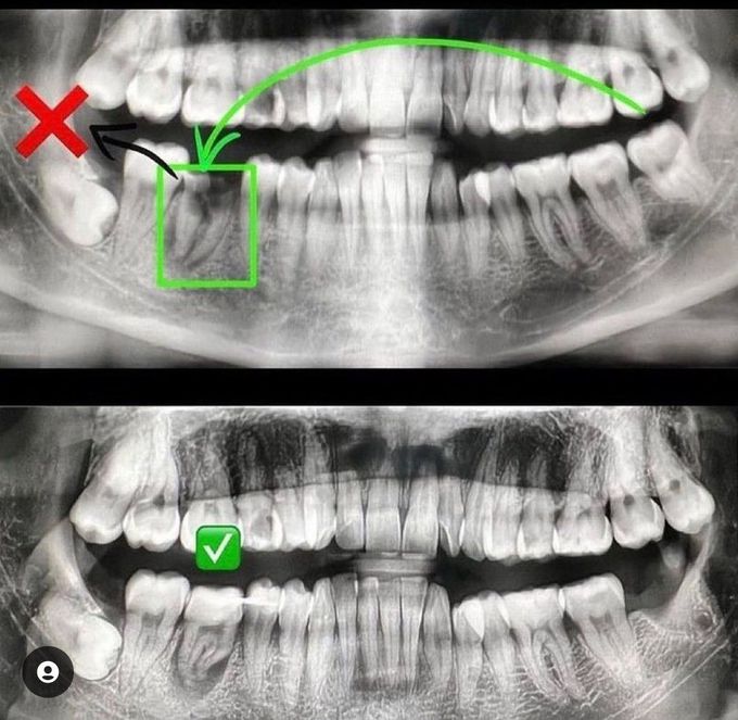 Autotransplantation