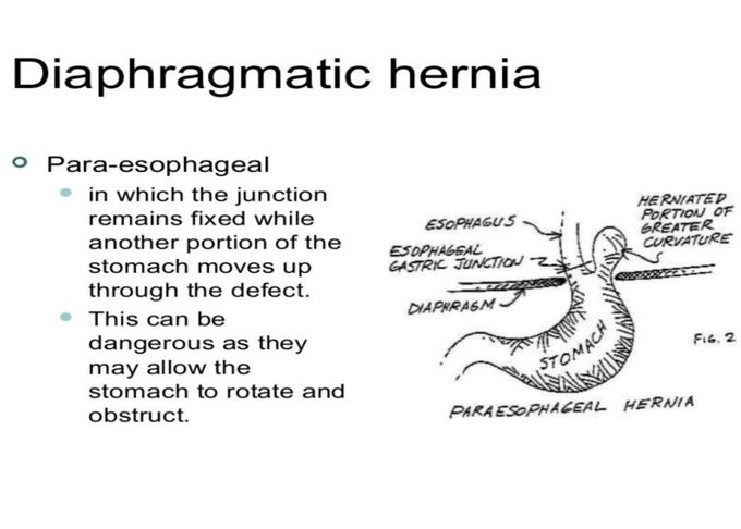 Diaphragmatic Hernia- Il