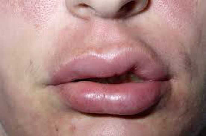 Cause of Angioedema