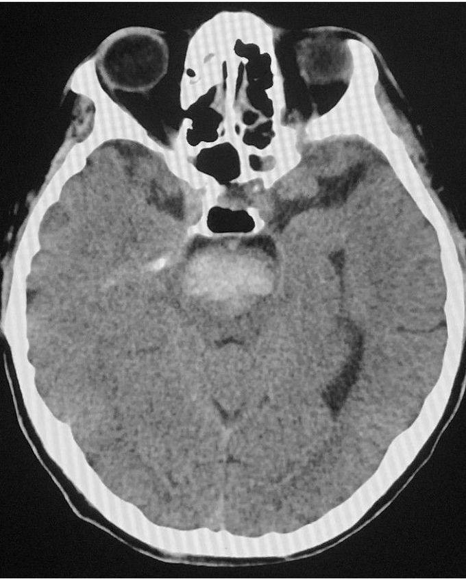 Spontaneous Intra-cerebral Hemorrhage