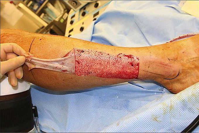 Removing the skin to create a graft! 