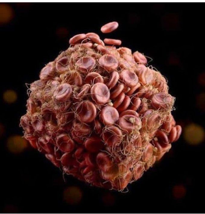 Blood clot