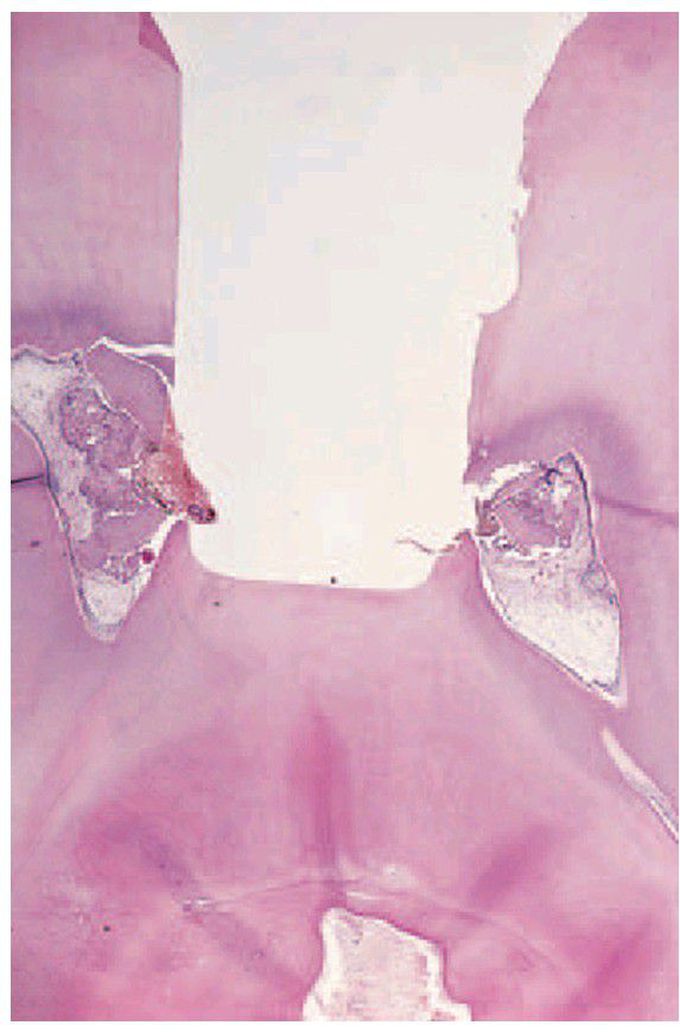 Traumatic exposure of pulp
