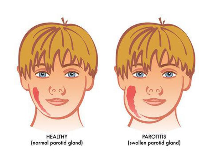 Mumps
