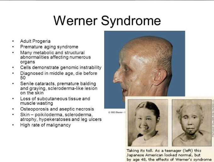 Werner's Syndrome