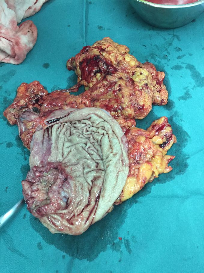 Total Gastrectomy