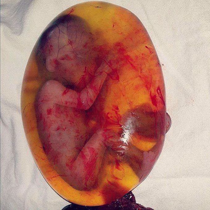 Spontaneous abortion of 18 weeks fetus
