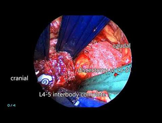 Minimally invasive L5–S1 oblique lumbar interbody fusion with anterior plate