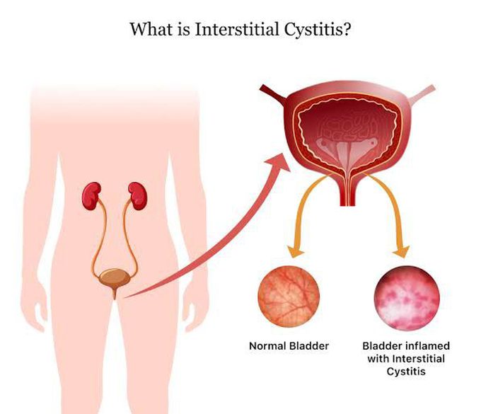 Causes of cystitis