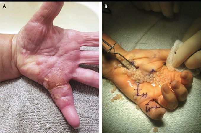 Rice Bodies in Tenosynovitis Due to Psoriatic Arthritis