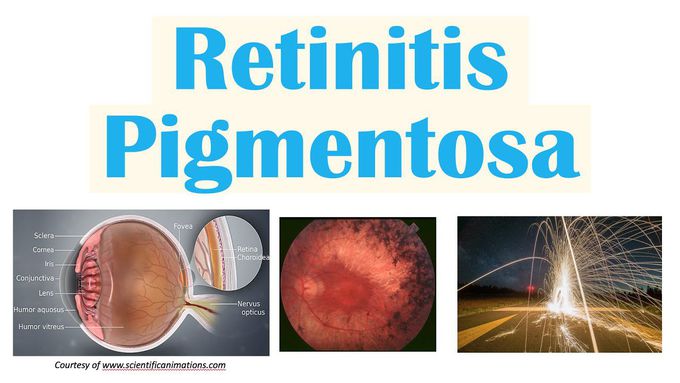 Retinitis Pigmentosa