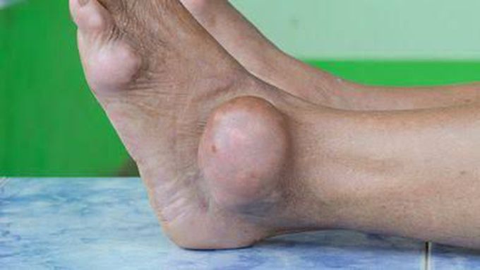 Gout