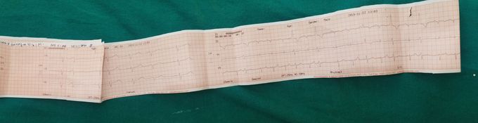 Heart failure...??? Interpret ecg findings...