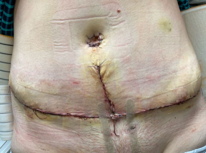 Abdominoplasty with suturing of the rectus muscles and moving the navel