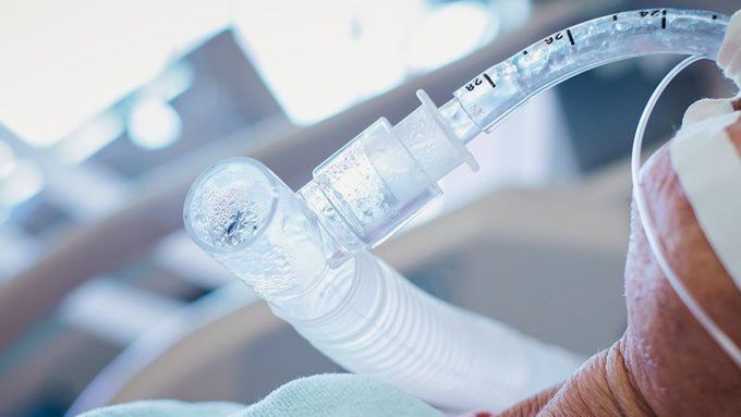 Postintubation Tracheal Injury in the COVID-19 Era