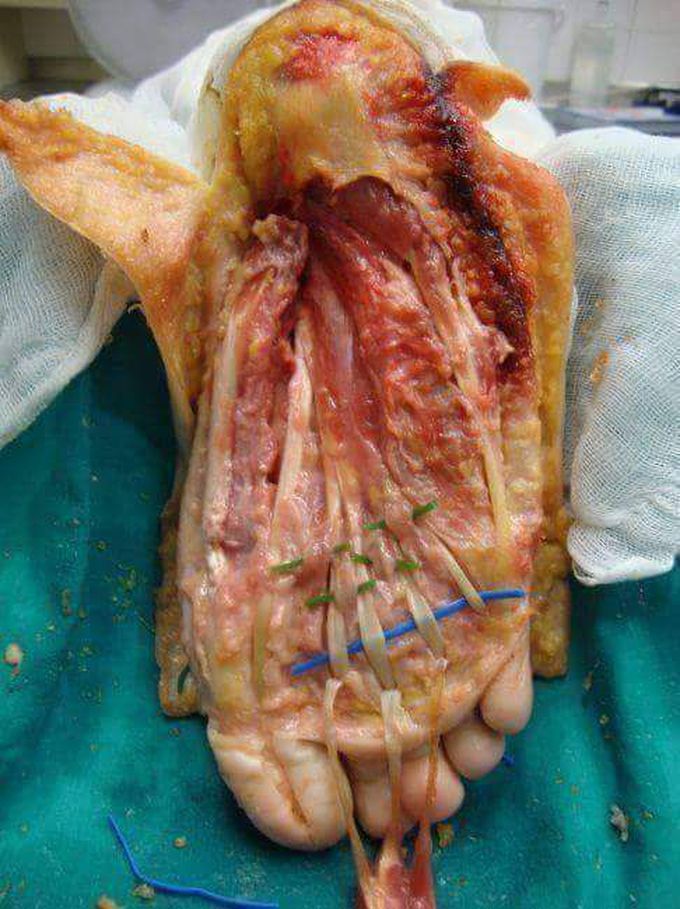 Tendons of the leg