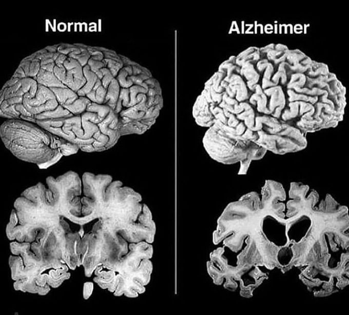 Alzheimer