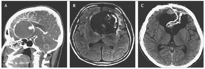 A Giant Aneurysm of the Anterior Communicating Artery