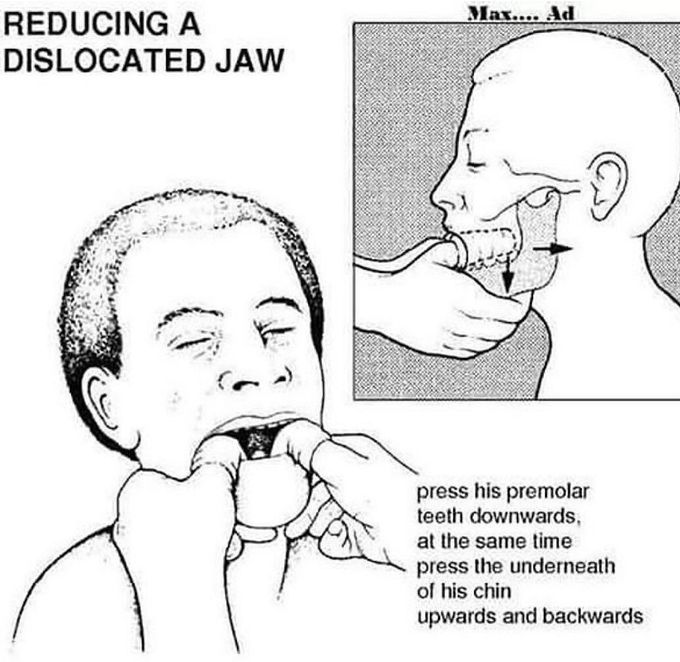 Reduction of Jaw Dislocation