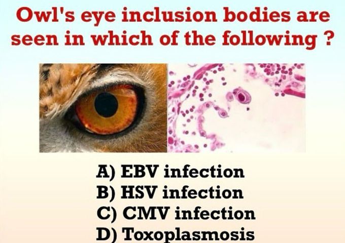 Owl's Eye Inclusion Bodies