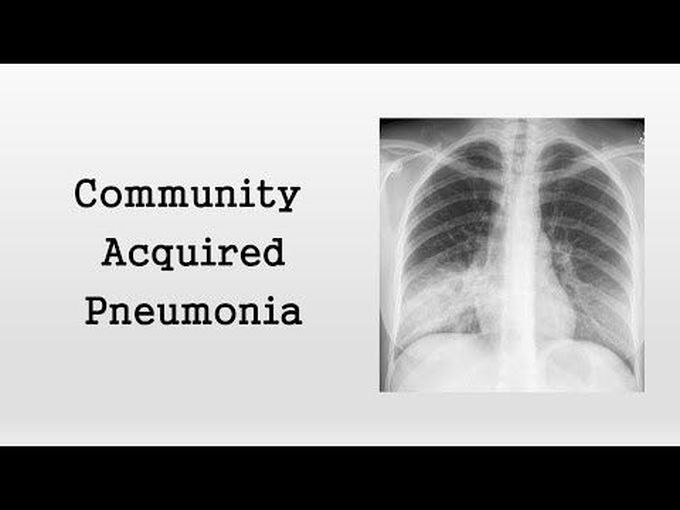 Introduction to Community-Acquired Pneumonia (CAP)
