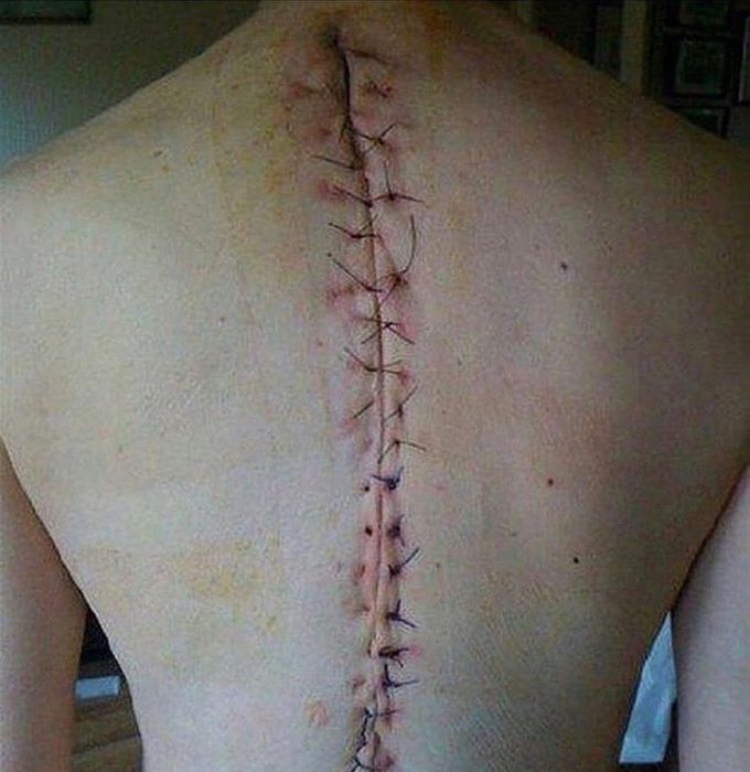 Suturing after scoliosis surgery
